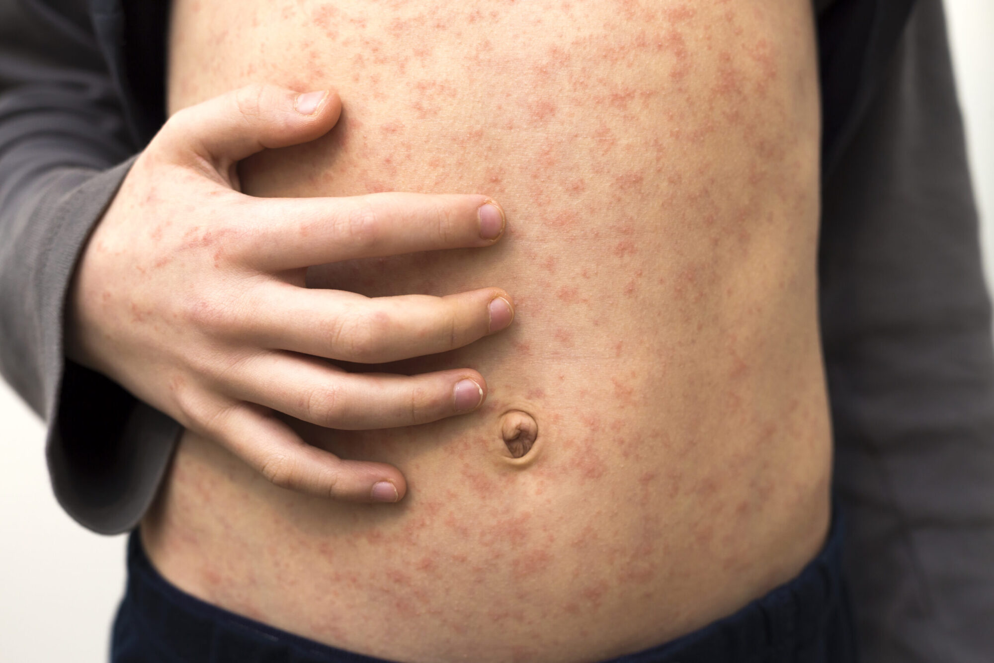 Sick child body, stomach with red rush spots from measles or chicken pox. Contagious child diseases and treatment.