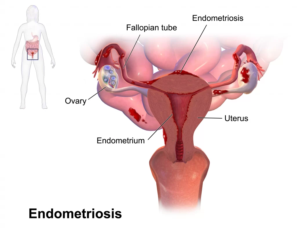 endométriose